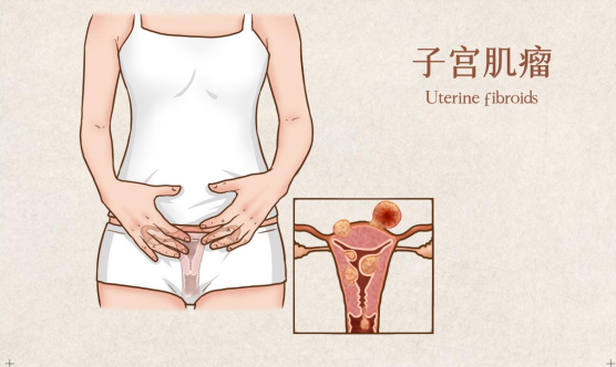 你的子宫条件达到做泰国试管婴儿的标准了吗？